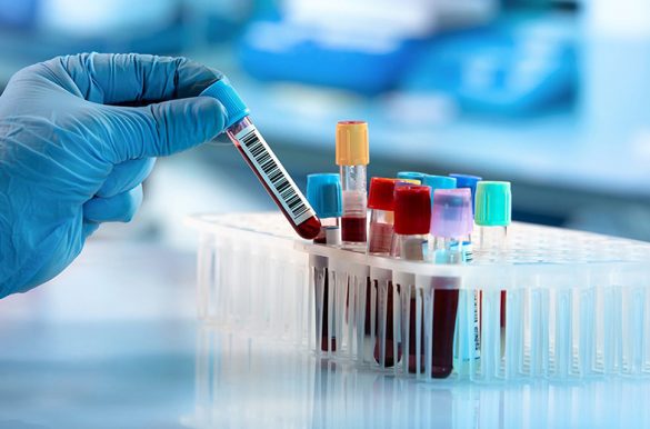 Hematology-585x386 Hematology 585x386 1